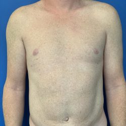 Liposuction Before & After Patient #2105
