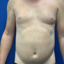 Liposuction Before & After Patient #2105