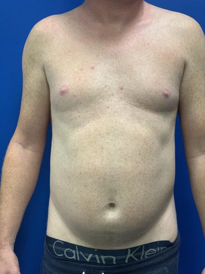 Liposuction Before & After Patient #2105
