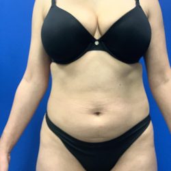Liposuction Before & After Patient #2106
