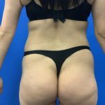 Liposuction Before & After Patient #2106