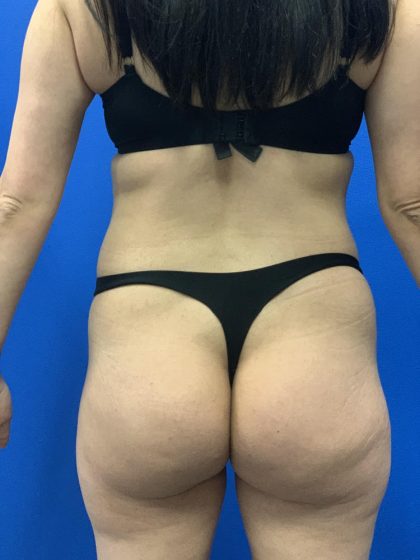 Liposuction Before & After Patient #2106