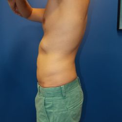 Liposuction Before & After Patient #2107