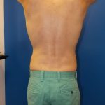 Liposuction Before & After Patient #2107