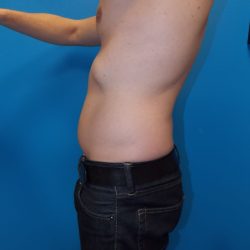 Liposuction Before & After Patient #2107