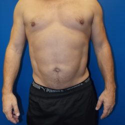 Liposuction Before & After Patient #2108