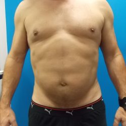 Liposuction Before & After Patient #2108