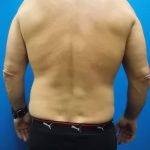 Liposuction Before & After Patient #2108