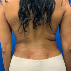 Liposuction Before & After Patient #2109