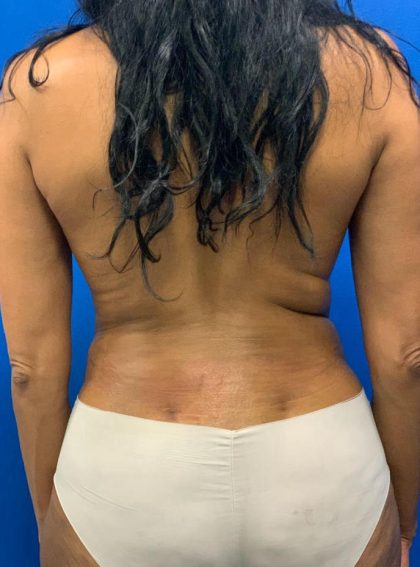 Liposuction Before & After Patient #2109