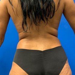 Liposuction Before & After Patient #2109