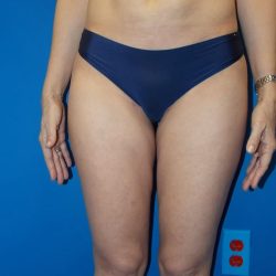 Liposuction Before & After Patient #2110
