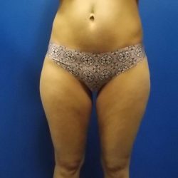 Liposuction Before & After Patient #2110