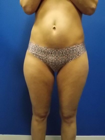 Liposuction Before & After Patient #2110