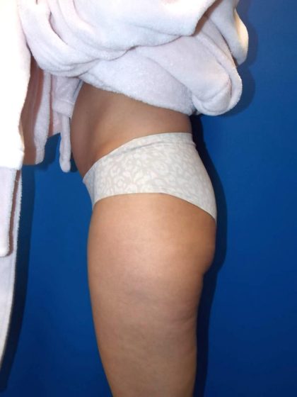 Liposuction Before & After Patient #2110