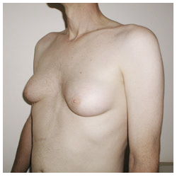 Gynecomastia Before & After Patient #1036