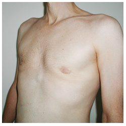 Gynecomastia Before & After Patient #1036