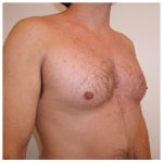 Gynecomastia Before & After Patient #1037