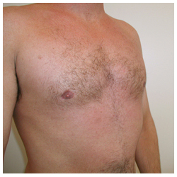 Gynecomastia Before & After Patient #1037