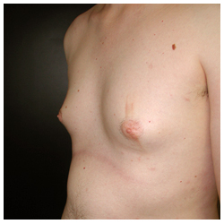Gynecomastia Before & After Patient #1038