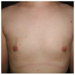 Gynecomastia Before & After Patient #1038