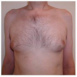 Gynecomastia Before & After Patient #1039
