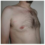 Gynecomastia Before & After Patient #1039