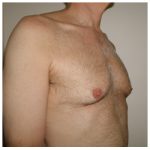 Gynecomastia Before & After Patient #1040
