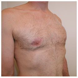 Gynecomastia Before & After Patient #1040