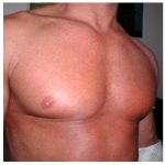 Gynecomastia Before & After Patient #1041