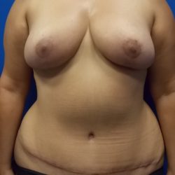 Mommy Makeover Before & After Patient #2116