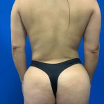 Brazilian Butt Lift Before & After Patient #2117