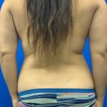 Brazilian Butt Lift Before & After Patient #2117
