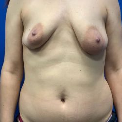 Mommy Makeover Before & After Patient #2118