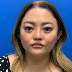 Rhinoplasty Before & After Patient #2061