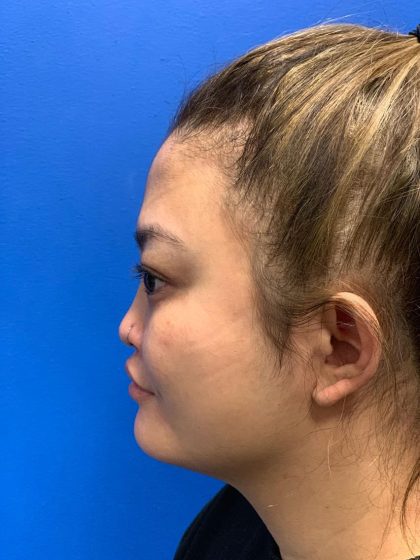 Rhinoplasty Before & After Patient #2061