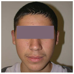 Otoplasty Before & After Patient #1003