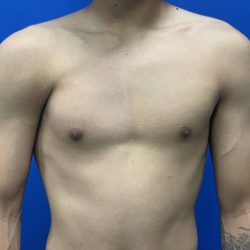 Poland Syndrome Before & After Patient #2120