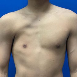 Poland Syndrome Before & After Patient #2120