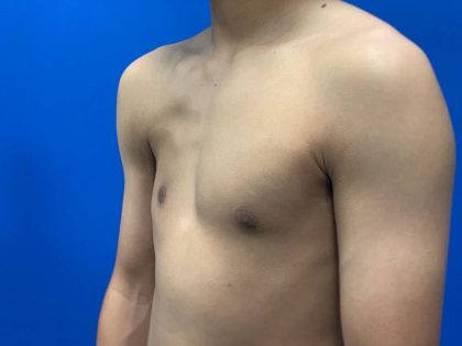 Poland Syndrome Before & After Patient #2120
