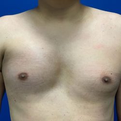 Poland Syndrome Before & After Patient #2129