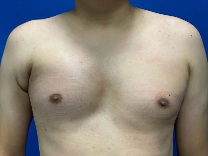 Poland Syndrome Before & After Patient #2129