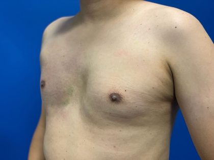Poland Syndrome Before & After Patient #2129