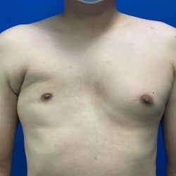Poland Syndrome Before & After Patient #2129