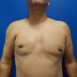 Poland Syndrome Before & After Patient #2130