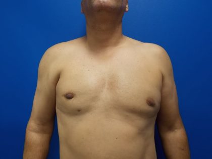 Poland Syndrome Before & After Patient #2130