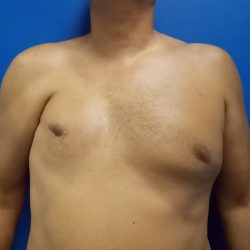 Poland Syndrome Before & After Patient #2130