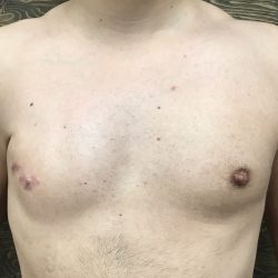 Poland Syndrome Before & After Patient #2131