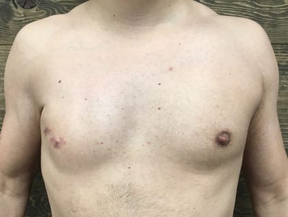 Poland Syndrome Before & After Patient #2131