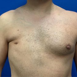 Poland Syndrome Before & After Patient #2131